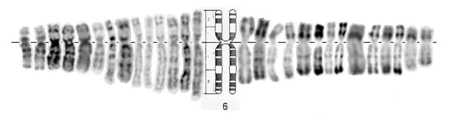 Chromosome 6p deletion
