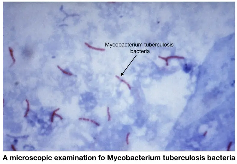 What is TB (Mycobacterium Tuberculosis) PCR?