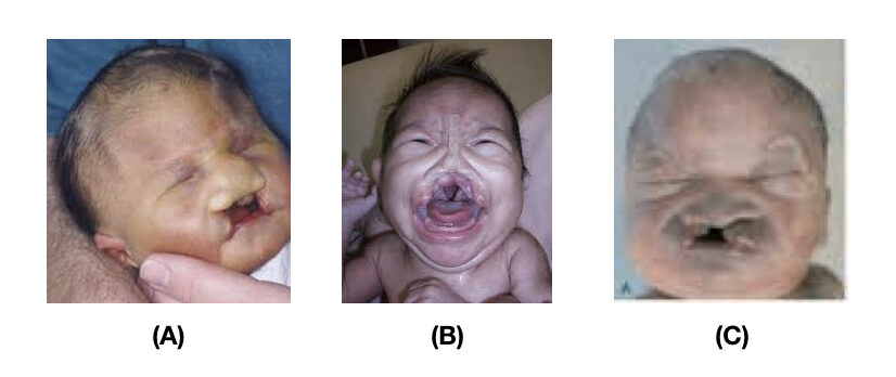 Facial abnormalities in trisomy 13.