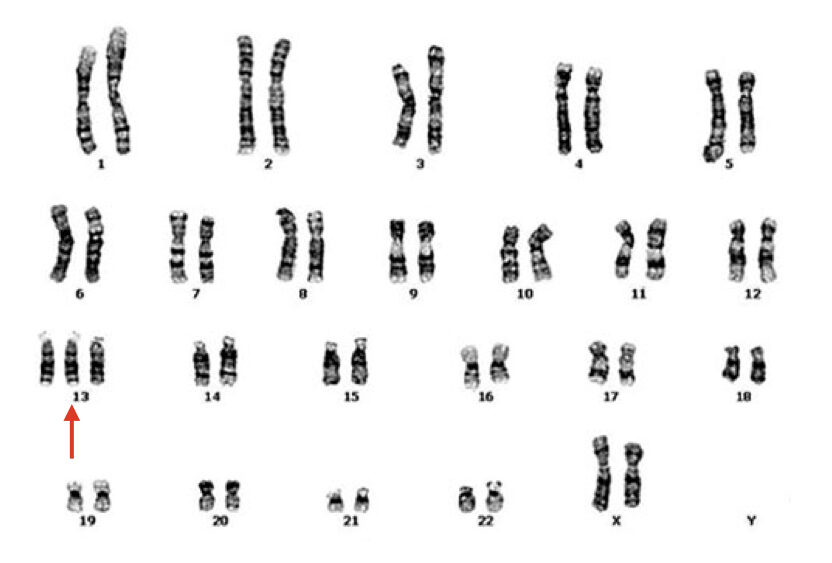 A karyotype of trisomy 13.