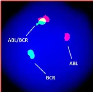 BCR-ABL1 gene fusion by FISH