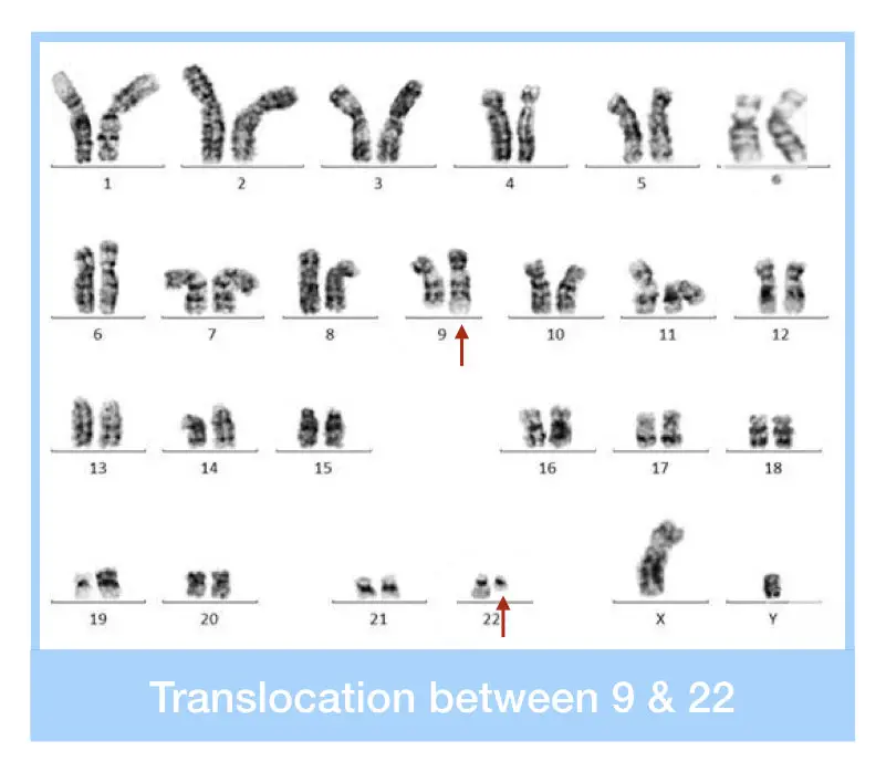 The karyotype image of translocation between chromosome 9 and 22. 
