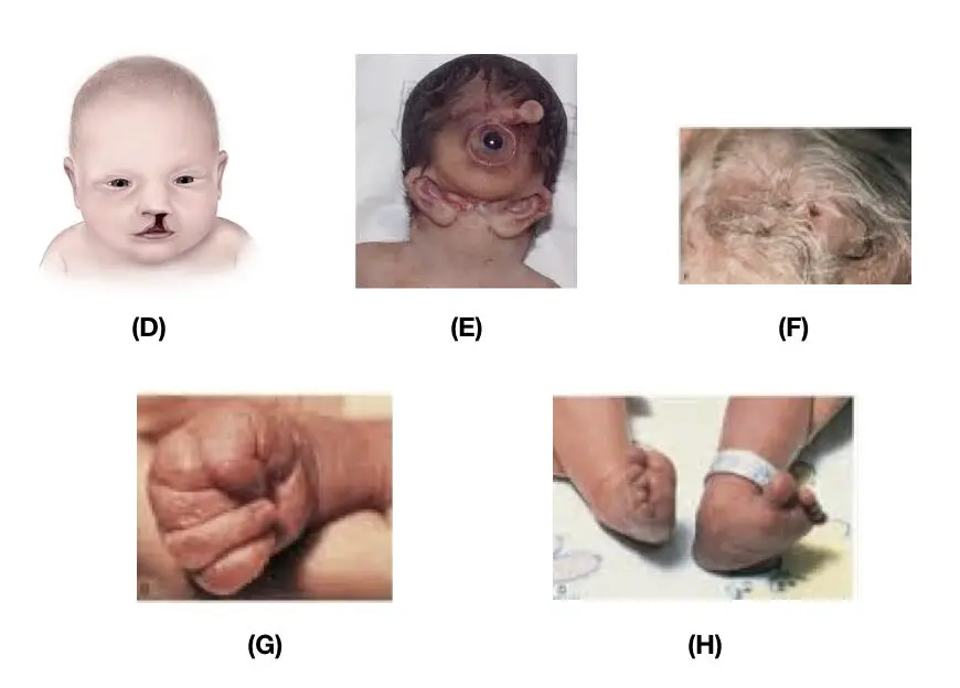 Patau syndrome physical characteristics