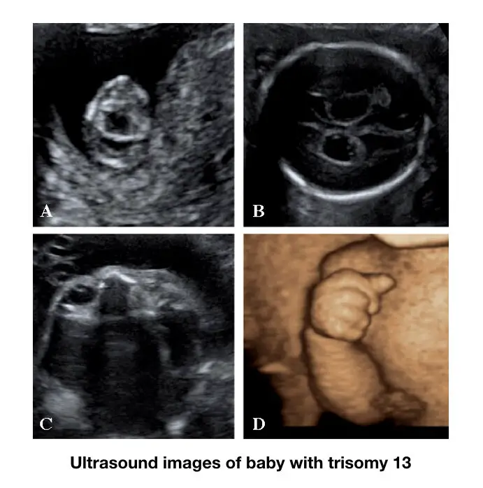 Trisomy 13 ultrasound image.