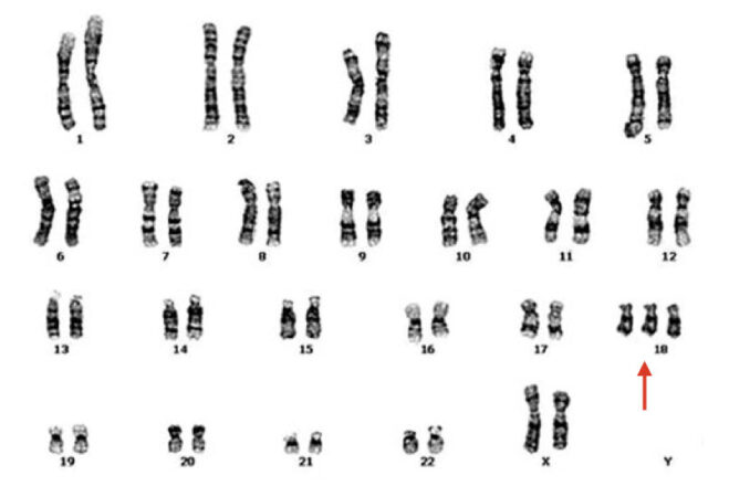 Trisomy 18- Definition, Symptoms, Pictures, Diagnosis And Life Expectancy