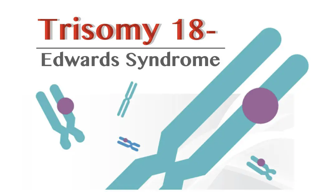Trisomy 18- Definition, Symptoms, Pictures, Diagnosis And Life Expectancy