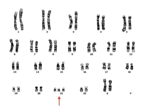 Trisomy 21 (Down Syndrome): Definition, Causes, Symptoms, Pictures and ...