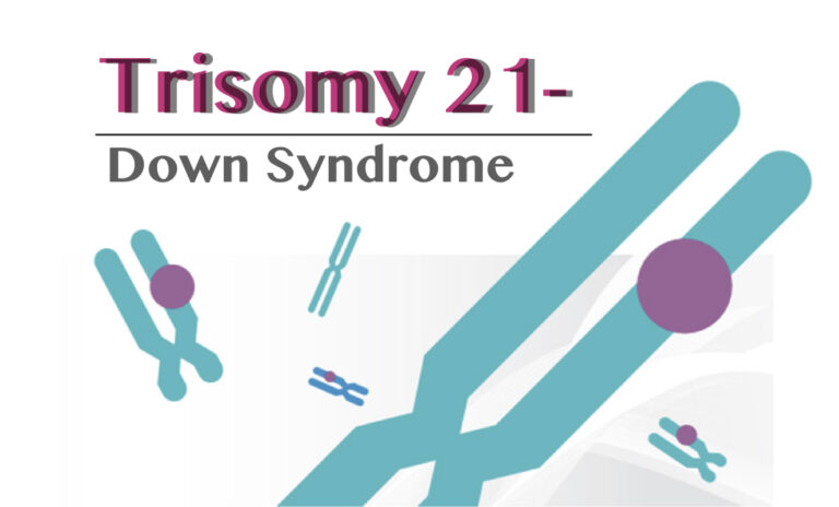 Trisomy 21 Down Syndrome Definition Causes Symptoms Pictures And 4947