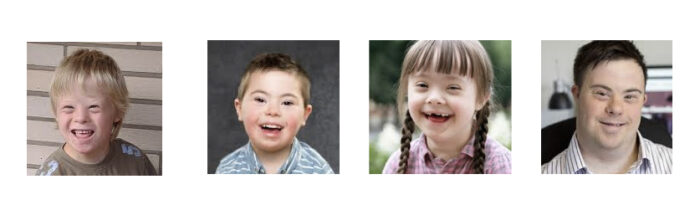 Trisomy 21 (Down Syndrome): Definition, Causes, Symptoms, Pictures and ...