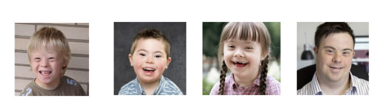 Trisomy 21 (Down Syndrome): Definition, Causes, Symptoms, Pictures And ...