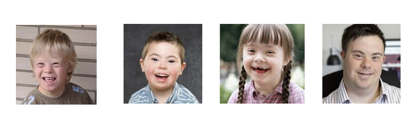 Trisomy 21 Down Syndrome Definition Causes Symptoms Pictures And Diagnosis