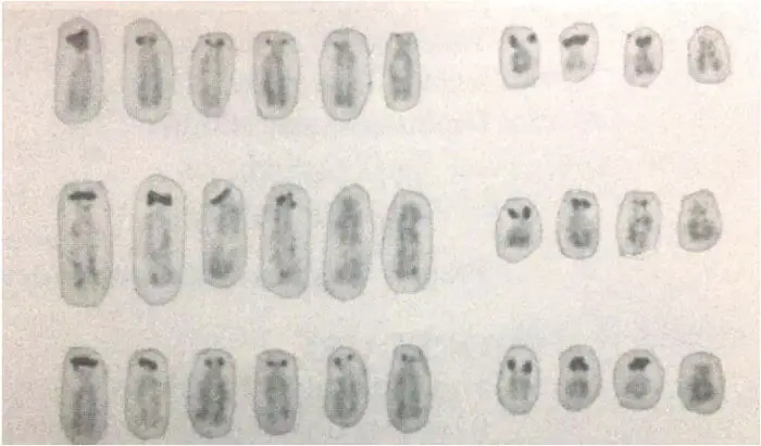 Karyotyping: Definition, Steps, Procedure And Applications – Genetic ...