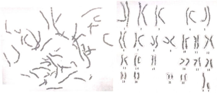 Karyotyping: Definition, Steps, Procedure And Applications – Genetic ...