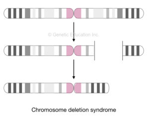 What Is Deletion Syndrome? Top 6 Chromosomal Deletion Syndromes Explained