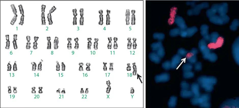 A karyotype showing chromosomal duplication