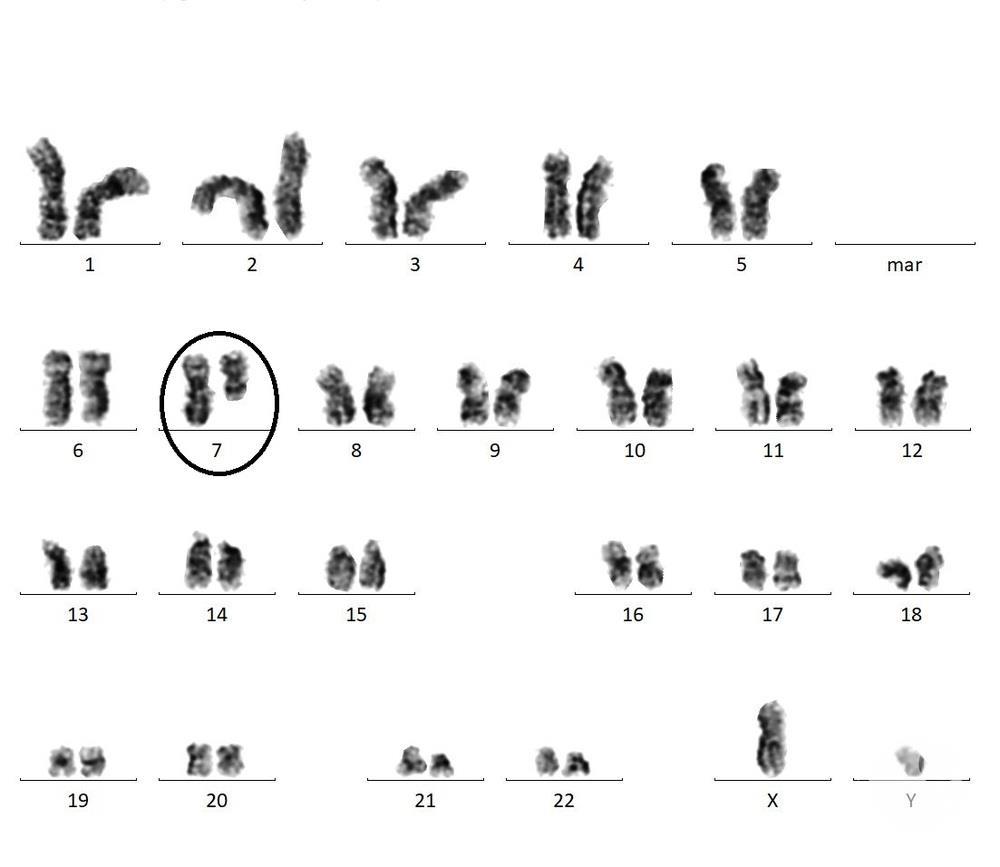 Karyotype of a chromosomal deletion. 