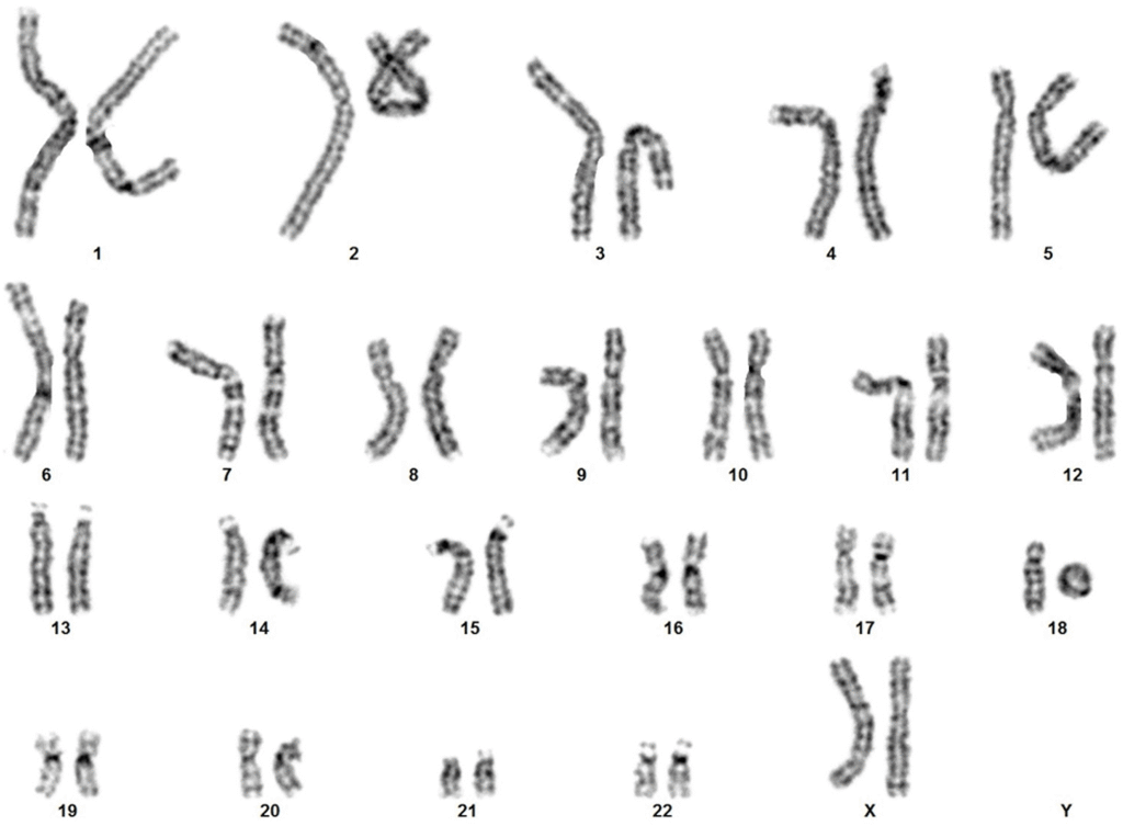 A karyotype showing ring chromosome 18.