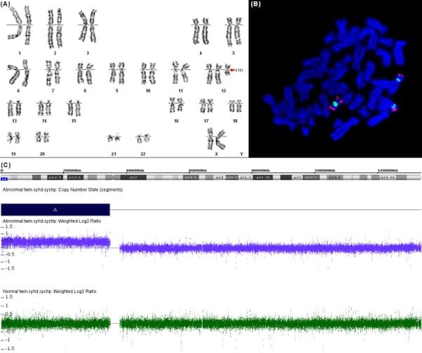 A case representation of Isochromosome. 